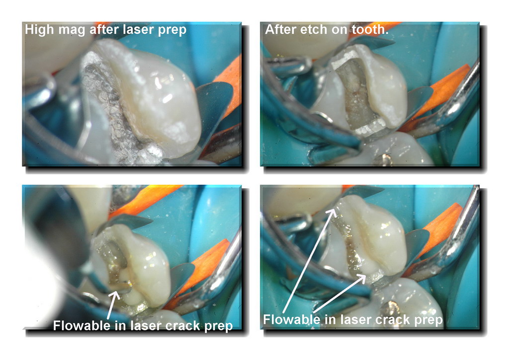 Cracked tooth pg 4_resize.jpg